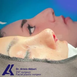 نمونه کار جراحی بینی