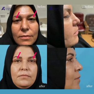 بلفاروپلاستی پلک-آرمین اکبری
