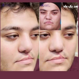 جراحی شکاف لب و کام-دکتر آرمین اکبری