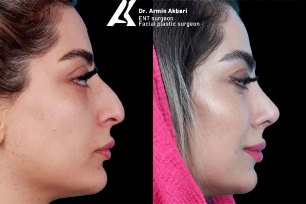 جراحی بینی استخوانی