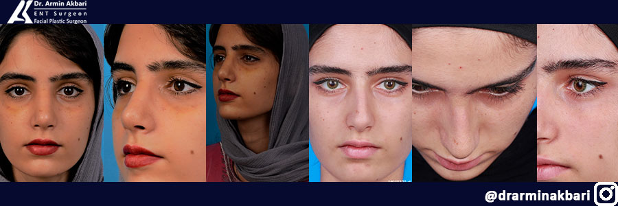 حذف قوز بینی استخوانی