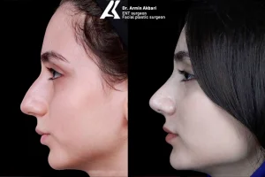 نحوه انجام عمل بینی استخوانی