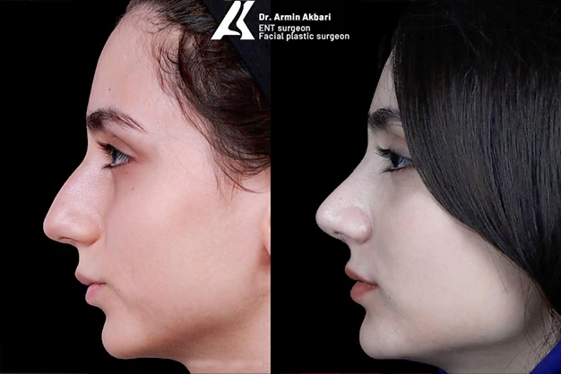 نحوه انجام عمل بینی استخوانی