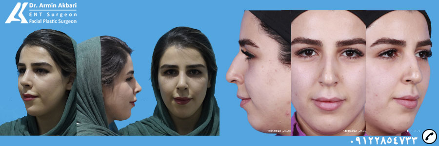 نمونه عمل بینی استخوانی