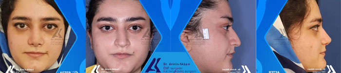 نمونه کار جراحی بینی گوشتی-دکتر آرمین اکبری
