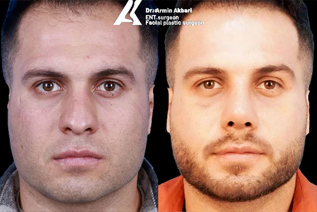 استاندارد عمل بینی مردانه