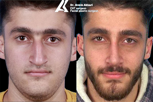 عمل بینی مردانه