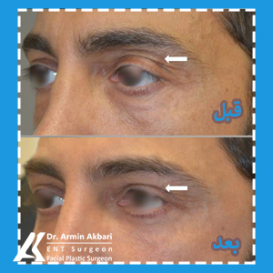 درمان-افتادگی-پلک-با-تزریق-ژل