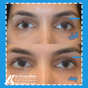 رفع-گودی-بالای-پلک-با-تزریق-ژل