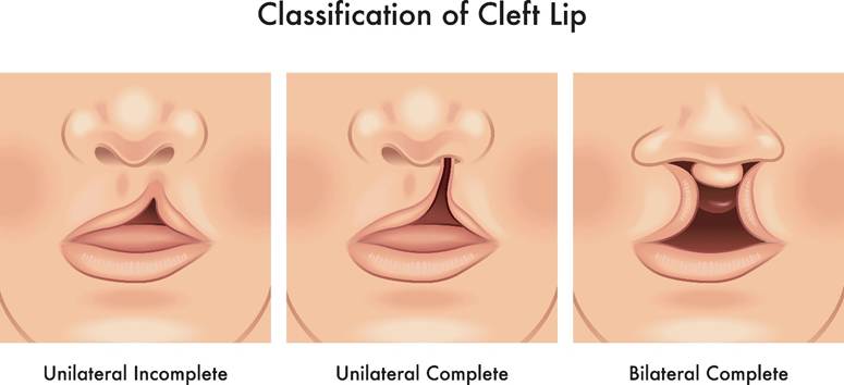 شکاف لب و کام