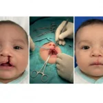 جراحی شکاف لب و کام