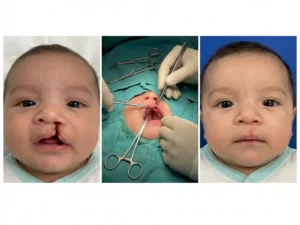 جراحی شکاف لب و کام