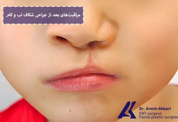 مراقبت‌های بعد از جراحی شکاف لب و کام