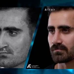 Cleft Lip and Rhinoplasty