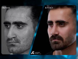Cleft Lip and Rhinoplasty