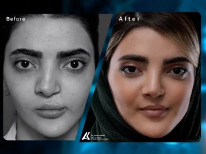Cleft Lip and Rhinoplasty surgery in Iran