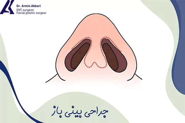 جراحی بینی باز