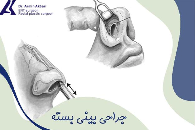 عمل جراحی بینی بسته
