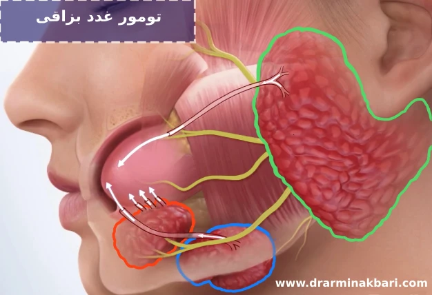 تومور غده بزاقی