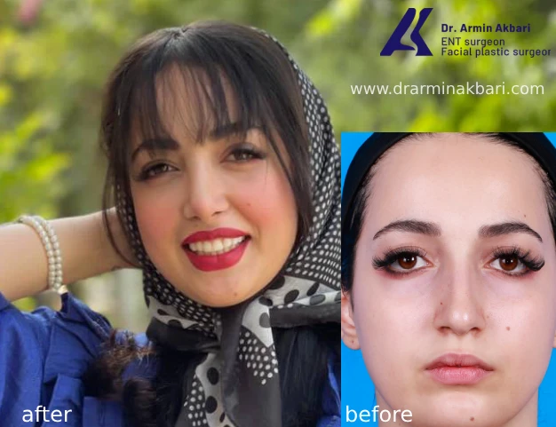 جراحی بینی نیمه فانتزی