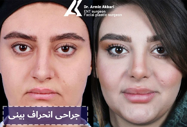 جراحی انحراف بینی
