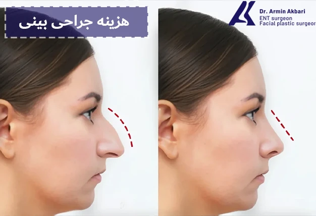 هزینه جراحی بینی
