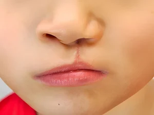 چگونگی تشخیص عفونت بعد از جراحی شکاف لب و کام