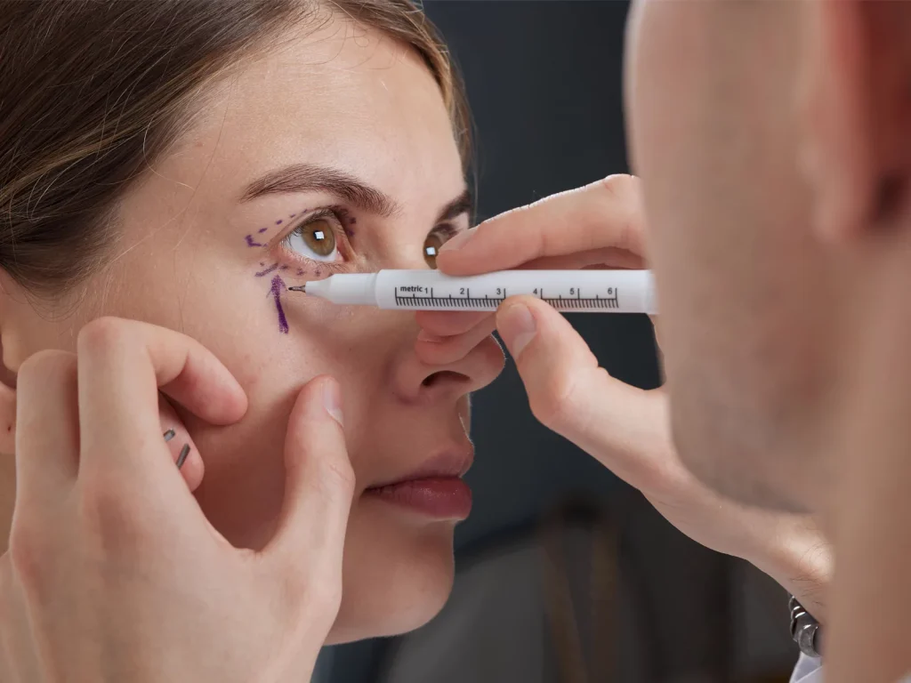 Blepharoplasty 001 The best surgeon for blepharoplasty in Iran