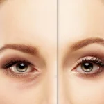 blepharoplasty