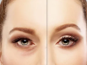 blepharoplasty