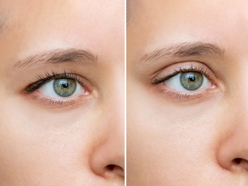 Blepharoplasty 003
