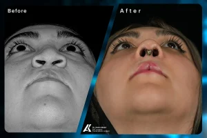 Cleft Lip and Palate Surgery