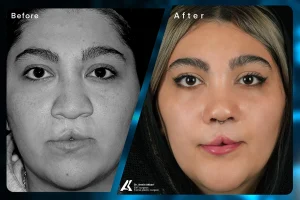 Cleft Lip and Palate Surgery