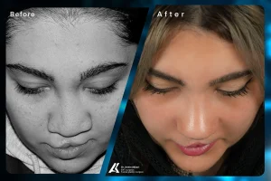 Cleft Lip and Palate Surgery