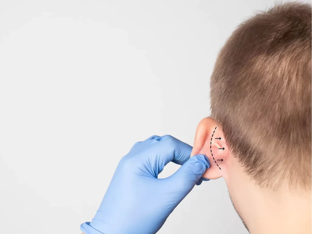 Otoplasty 001