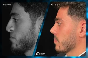 افتادگی بینی