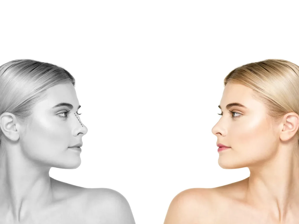 Rhinoplasty
