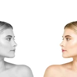 Rhinoplasty