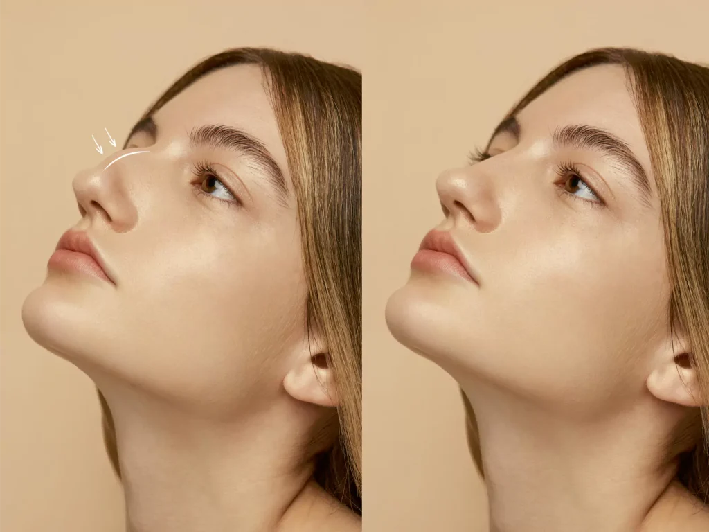 effect of rhinoplasty