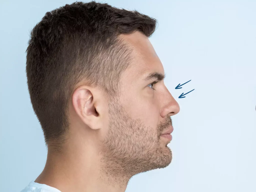 natural rhinoplasty