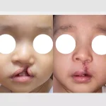 خطرات احتمالی جراحی ترمیم لب شکری