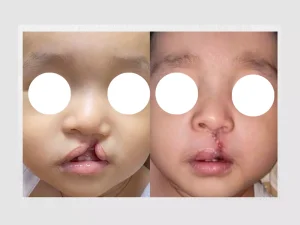 خطرات احتمالی جراحی ترمیم لب شکری