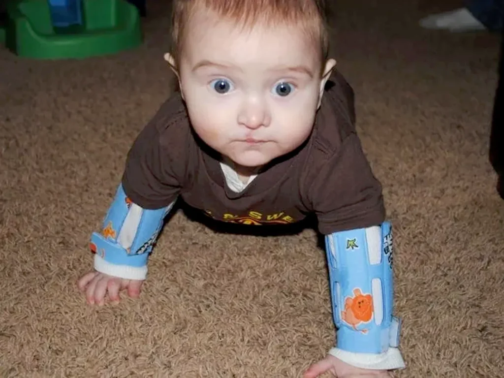 مراقبت های ضروری بعد از جراحی لب شکری و بستن آتل برای کودک