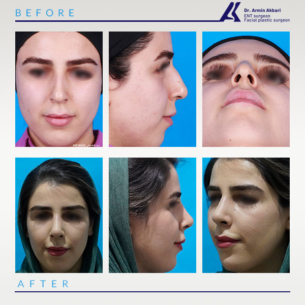 Natural rhinoplasty