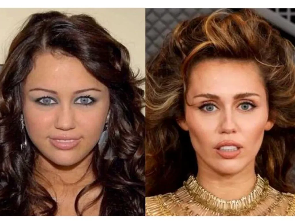 Miley Cyrus before after nose job