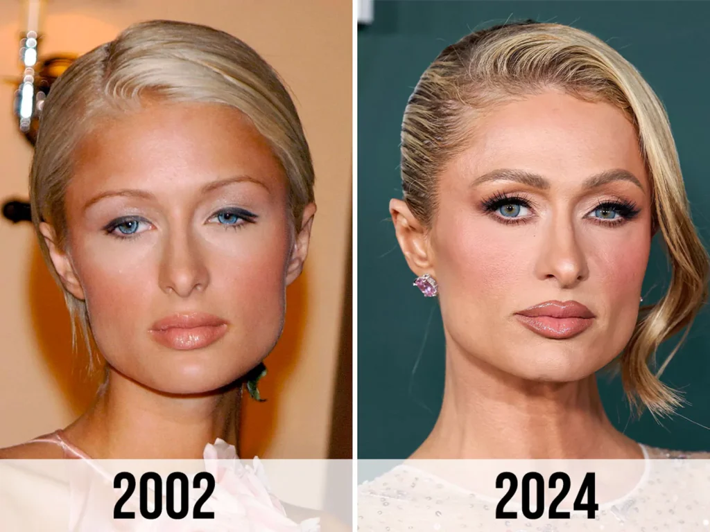 Paris Hilton before after nose job