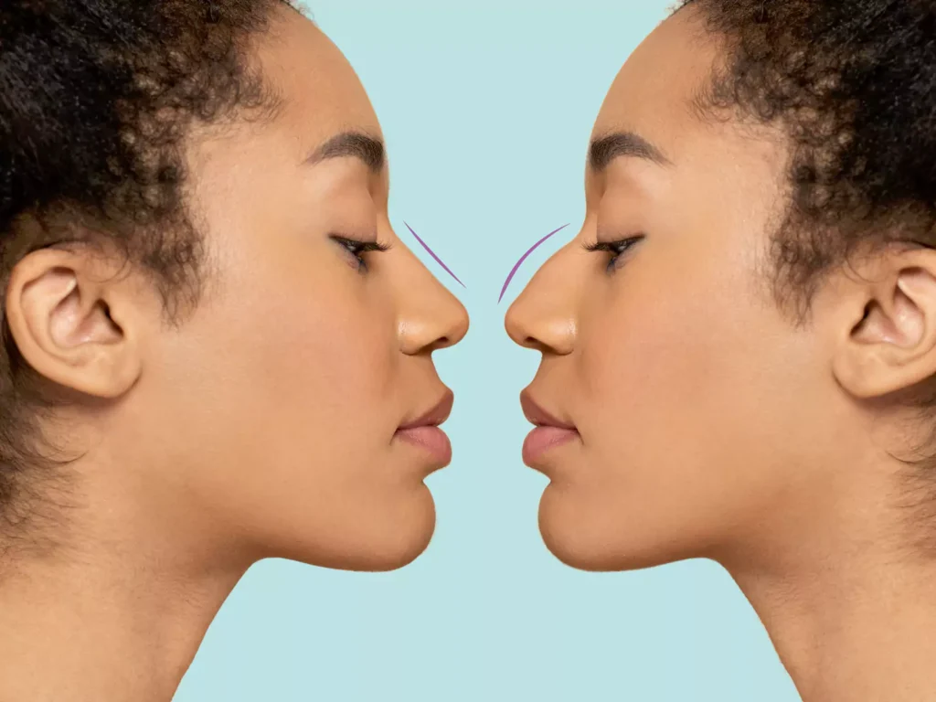 the nose change after rhinoplasty