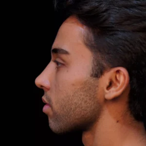 Before after rhinoplasty image by Dr. Armin Akbari
