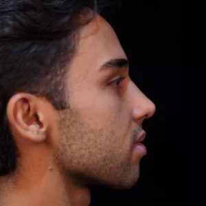 Before after rhinoplasty image by Dr. Armin Akbari