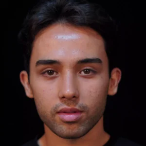 Before after rhinoplasty image by Dr. Armin Akbari